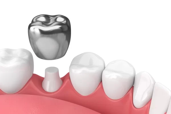 dental crowns dental crowns