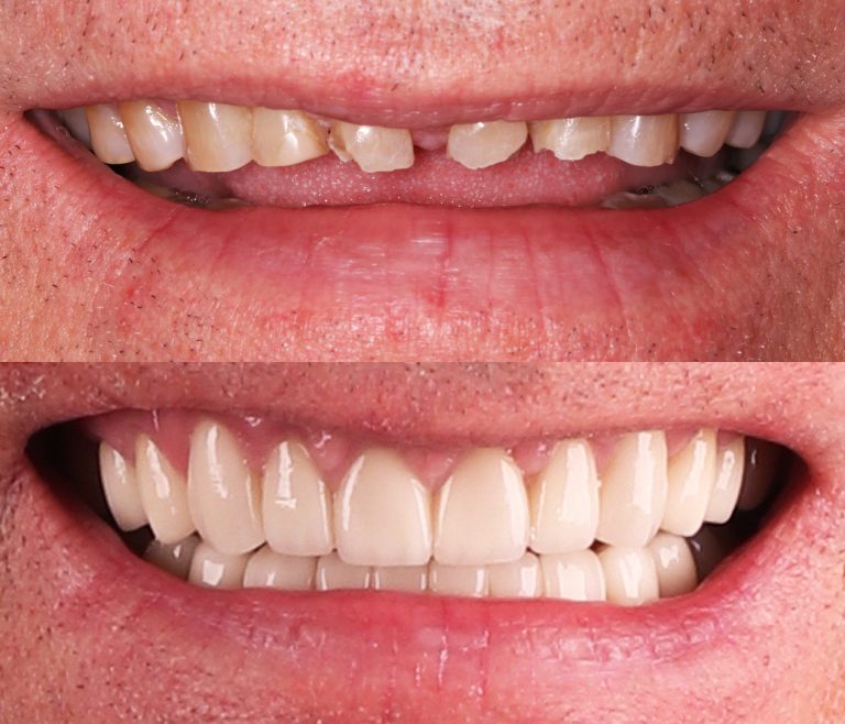A Brighter Smile after treatment
