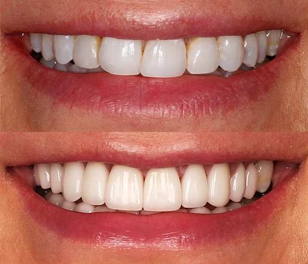 Smile Transformation after treatment