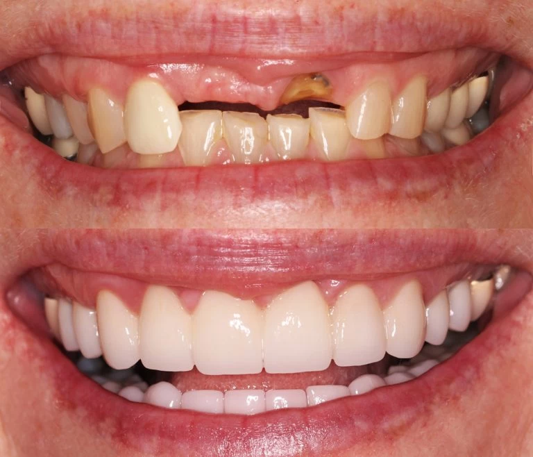 A Straighter Smile after treatment