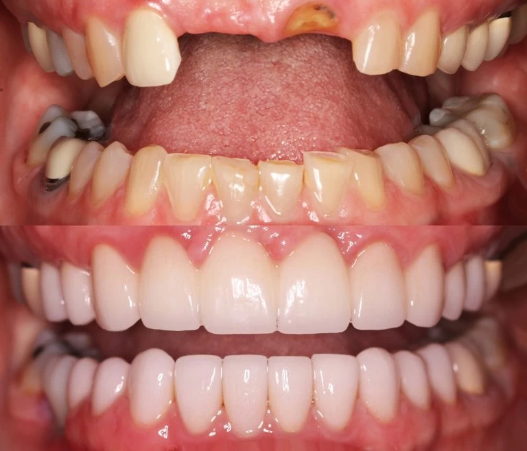 Complete Smile Renewal after treatment